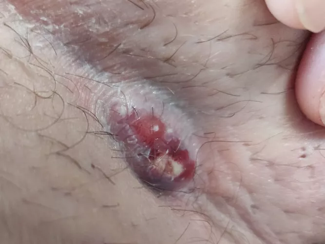 Boil in my groin, wait for the pop! 