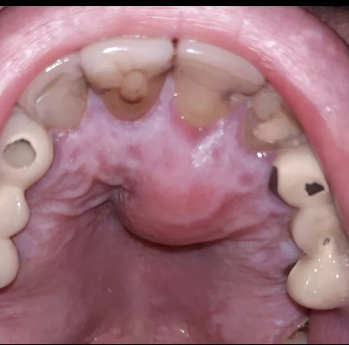 Abscess roof of mouth followed root canal 