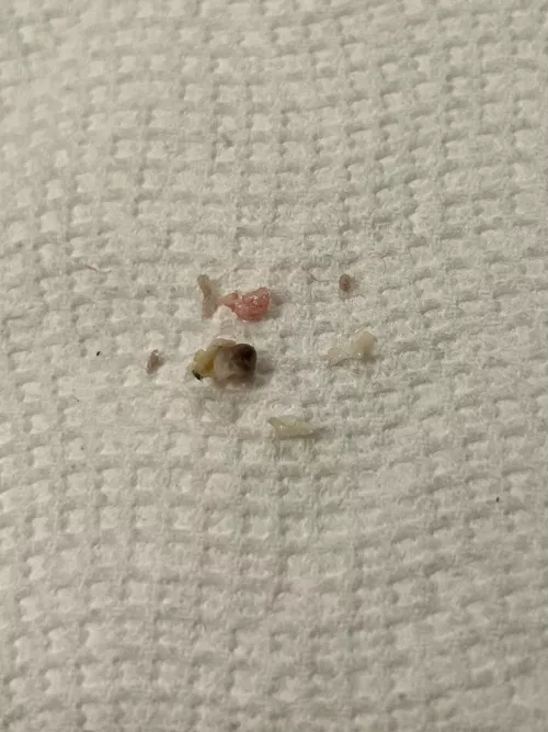 The grody results of what I thought was a regular pimple on my inner thigh from chafing! Wish I'd thought to record the very bloody cyst pop 🍾