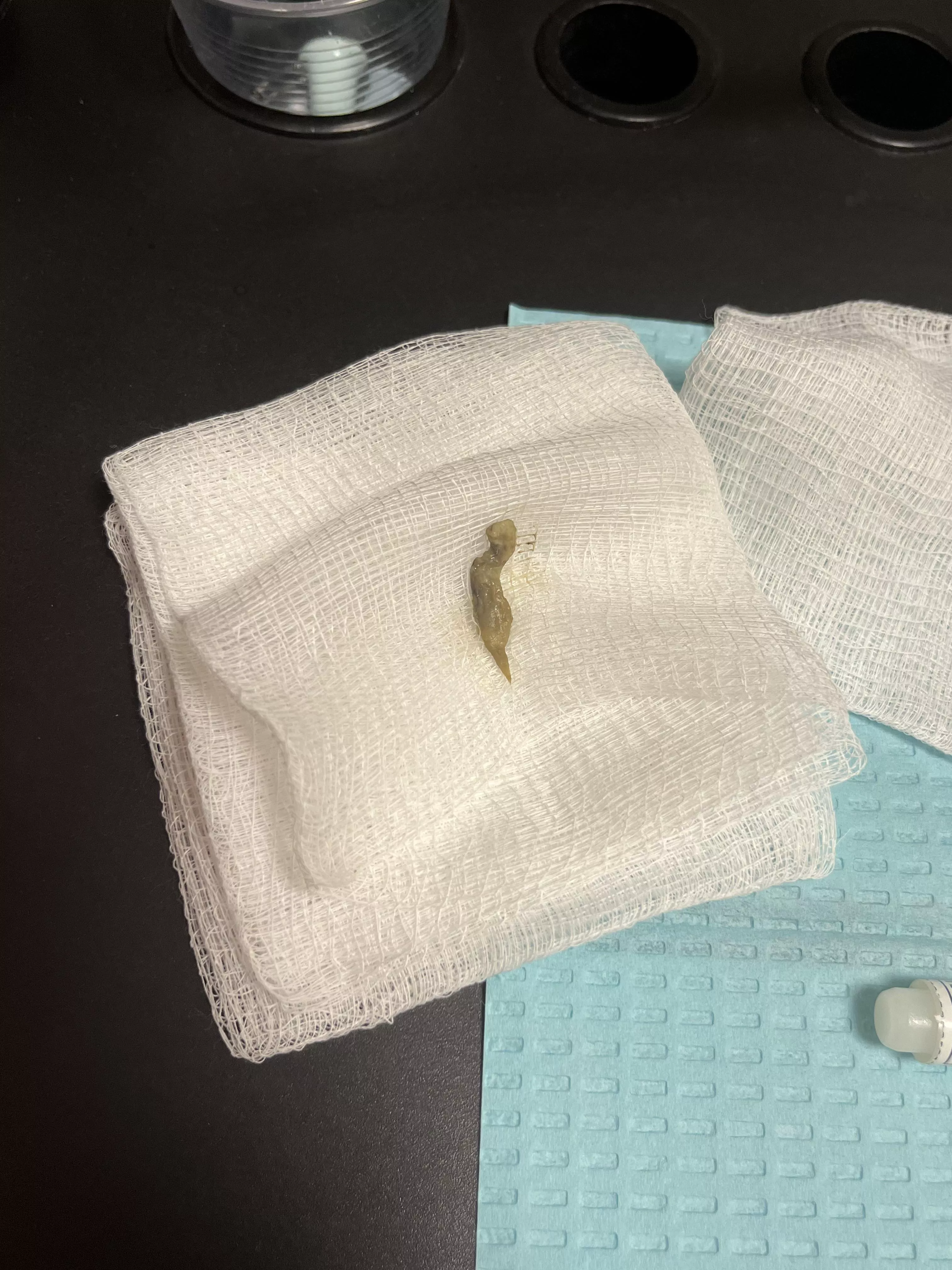 Had ear pain and couldn’t hear for a couple months. After many rounds of ear drops I went to an ENT and they pulled this out