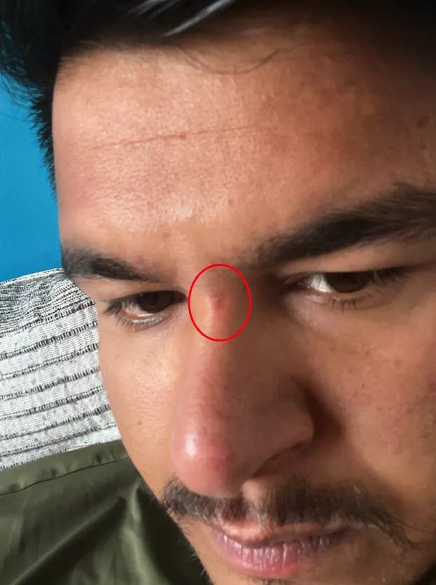 I scratched my face, and a thin layer of skin was removed. Afterward, a scab formed, which I peeled off. Since then, the skin has darkened, and it now looks black, although it appears pink in the picture. Please help me correct the appearance of my skin