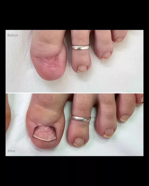 Anyone else with the same toenail missing situation?