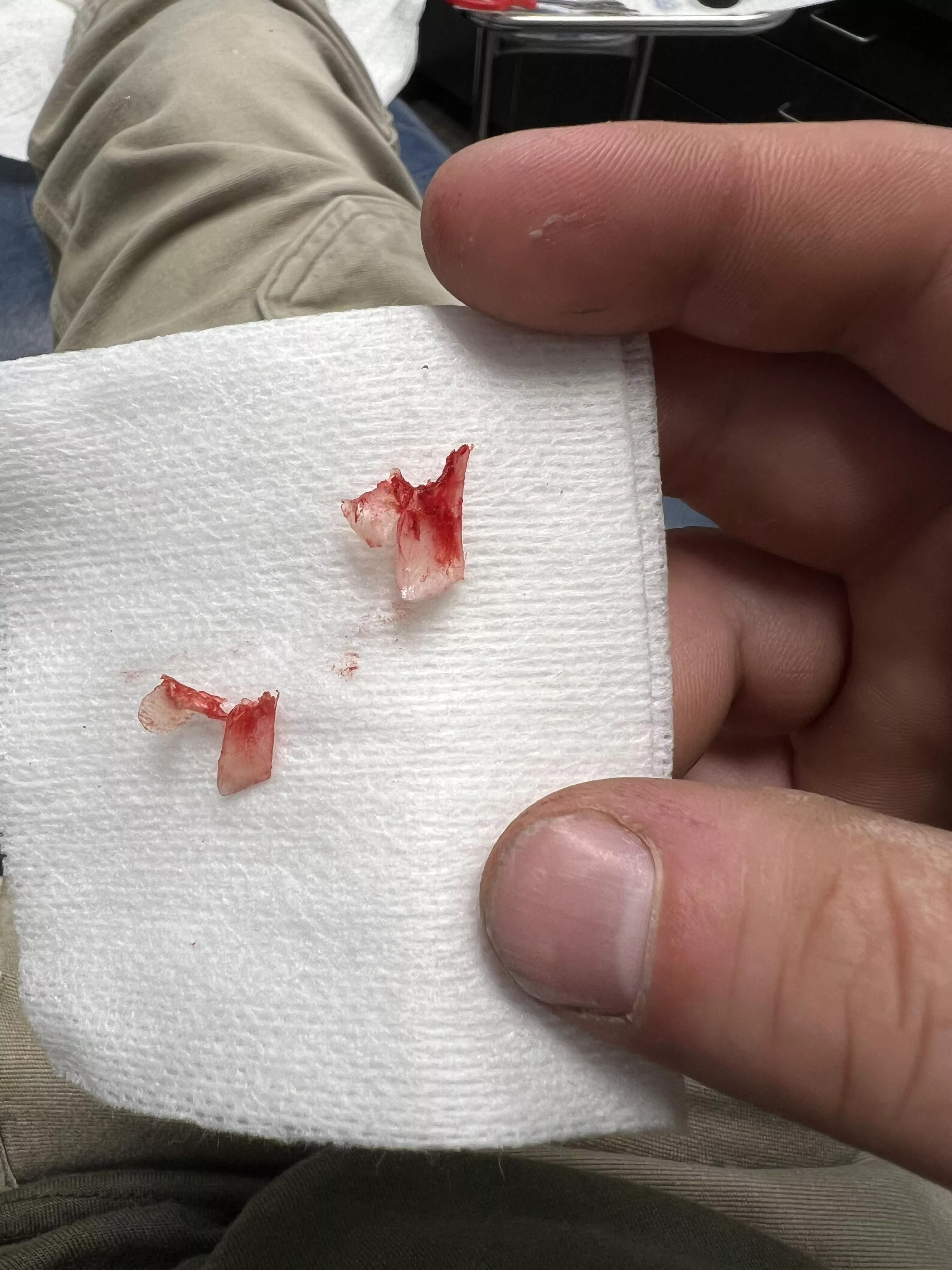 Ingrowns I had removed today