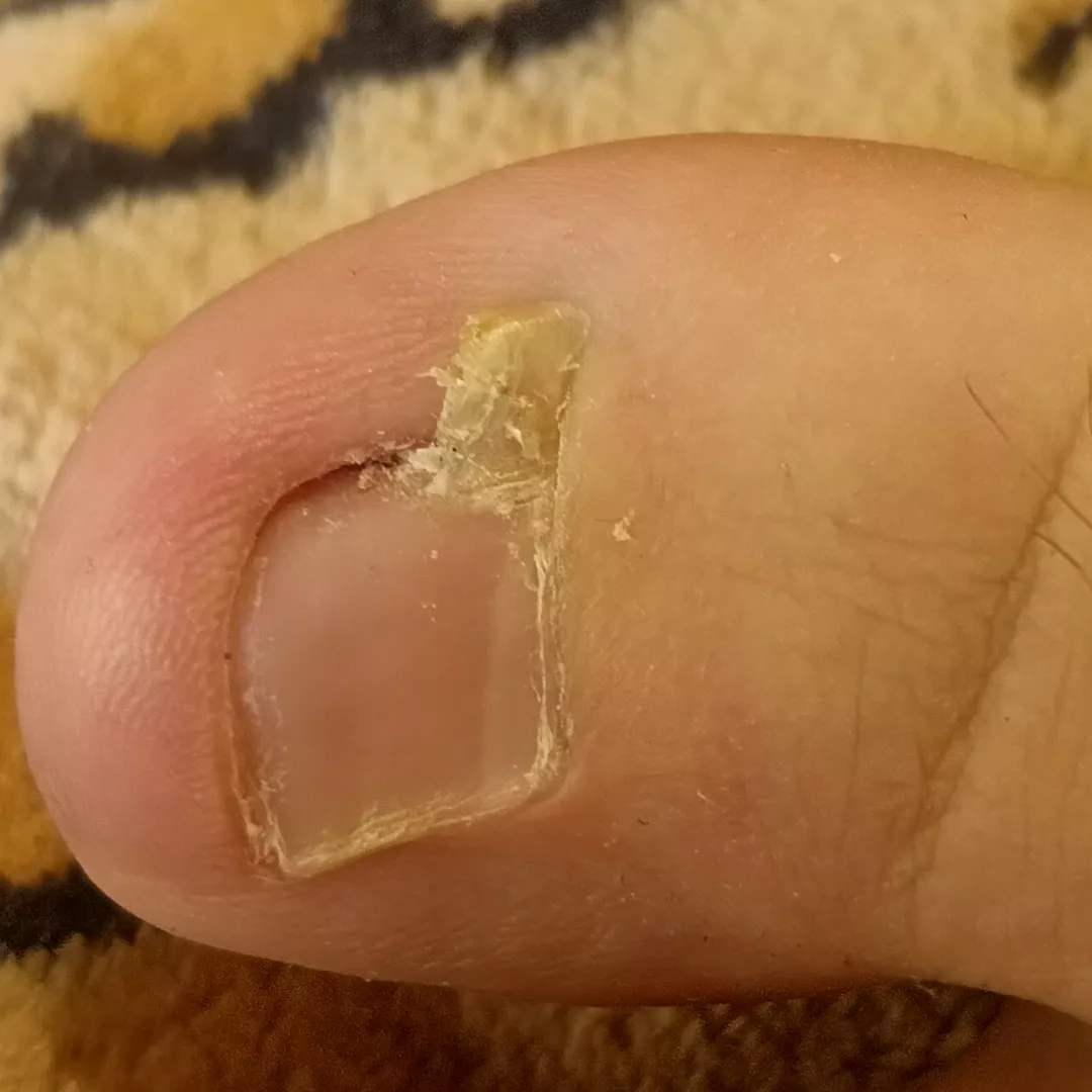 Finally popped this ingrown part of toenail out of my toe.