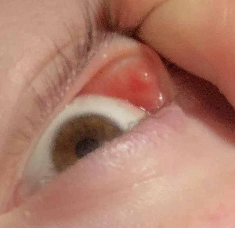 Potential eye pimple?