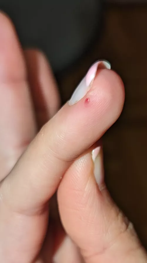Had this thing on my finger for a while, it was always red, but it just popped, any idea what it could be?
