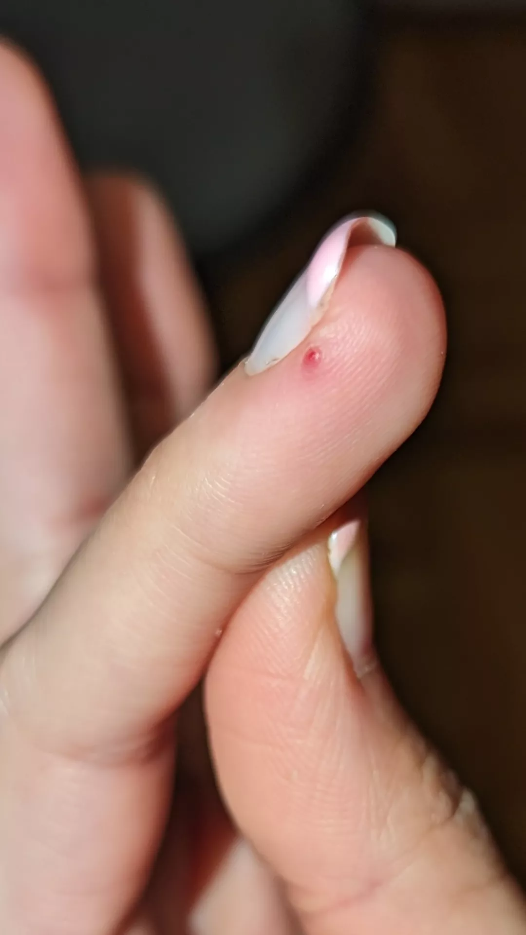 Had this thing on my finger for a while, it was always red, but it just popped, any idea what it could be?