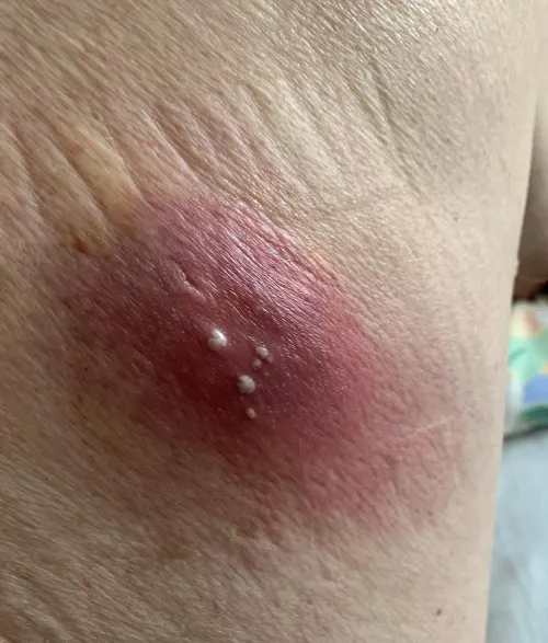 Abscess on my dad’s back