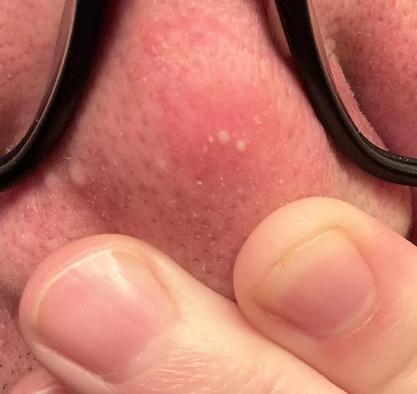 Sometimes my CPAP irritates my nose