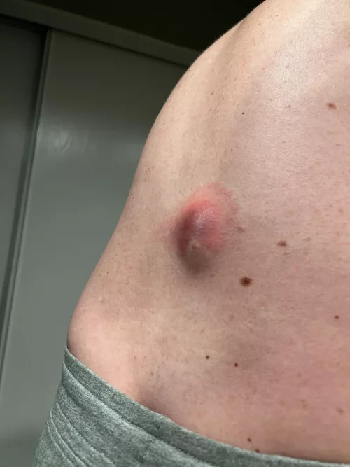 20-year old back cyst finally ruptured, a week before my surgery -_-
