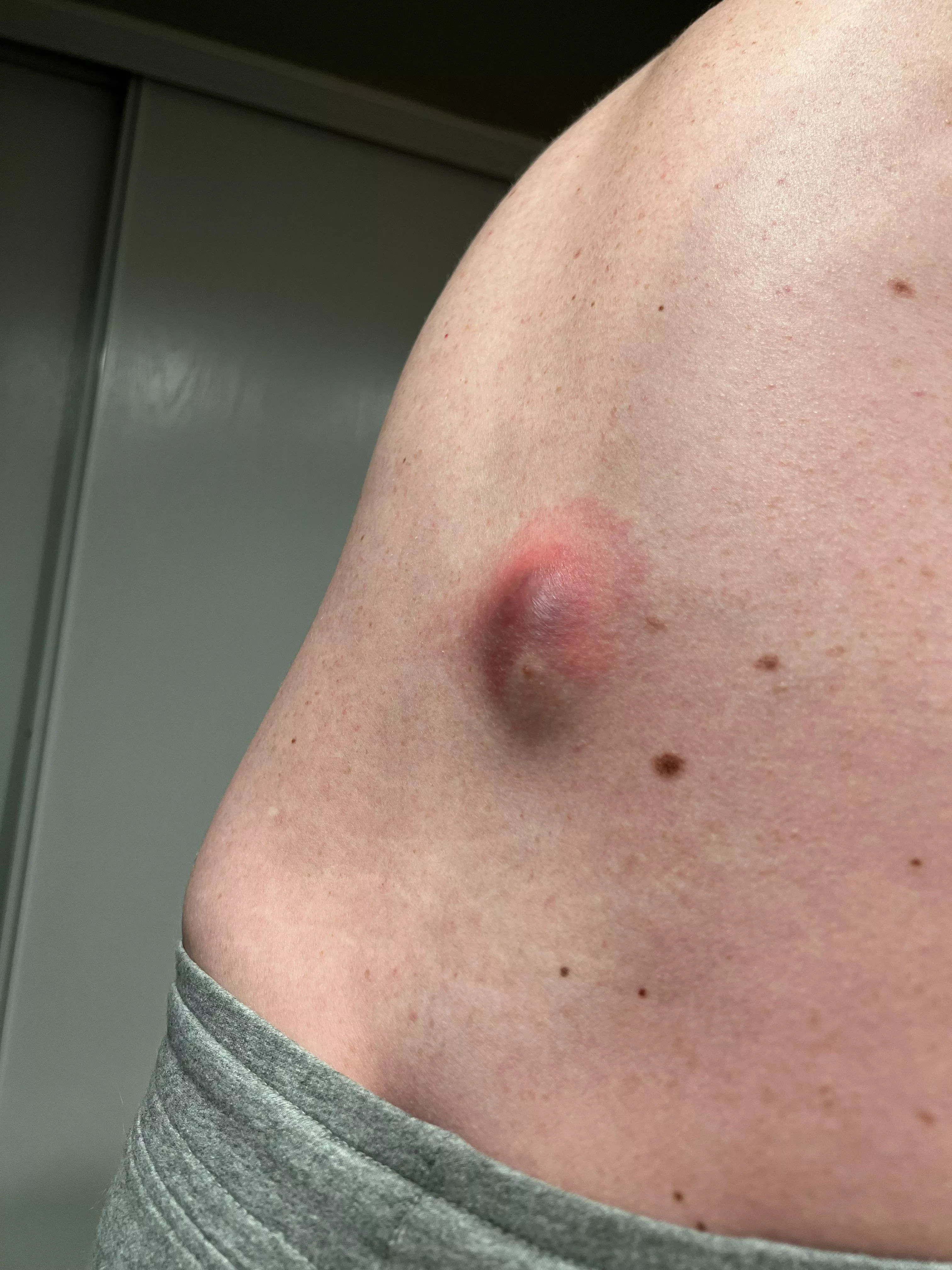 20-year old back cyst finally ruptured, a week before my surgery -_-