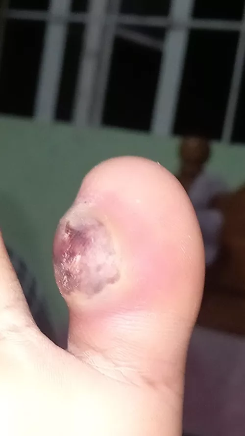 Foot infection? Cyst?