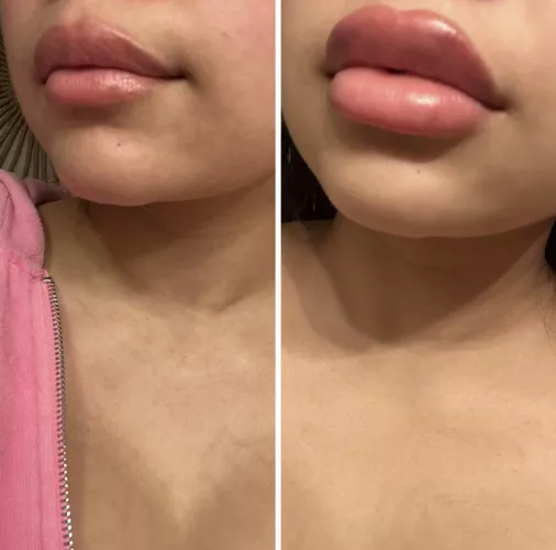Lip filler progress! Can’t wait for more