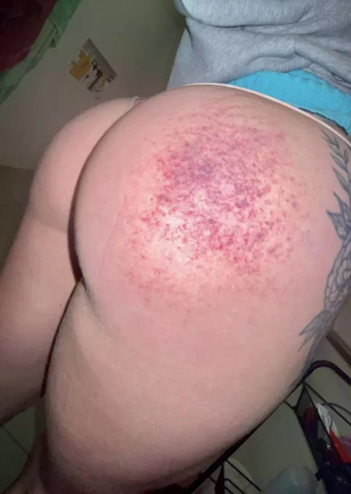 Bruising is coming up real nice 🥰