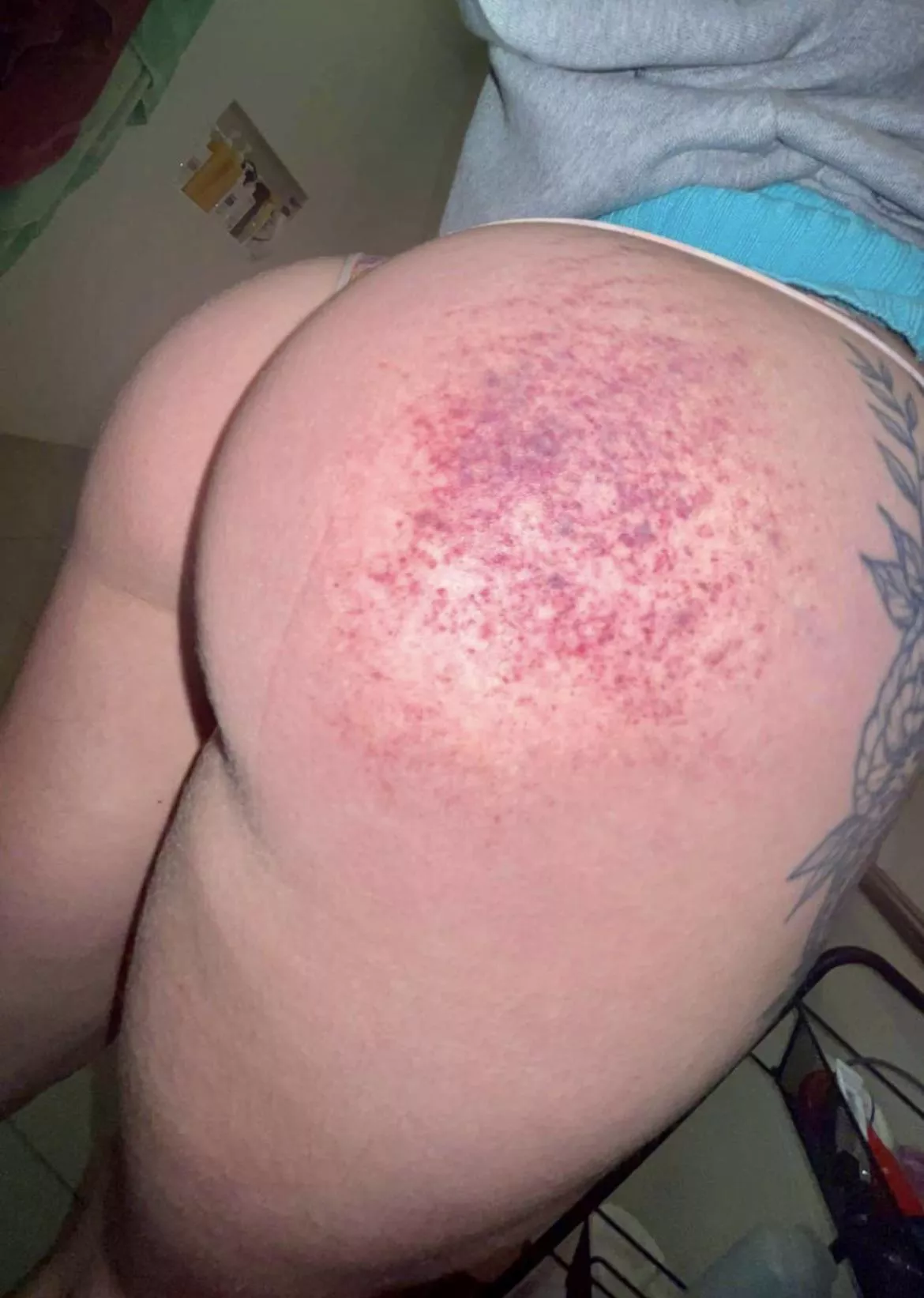 Bruising is coming up real nice 🥰