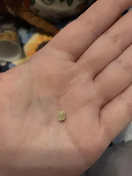 My biggest tonsil stone ever