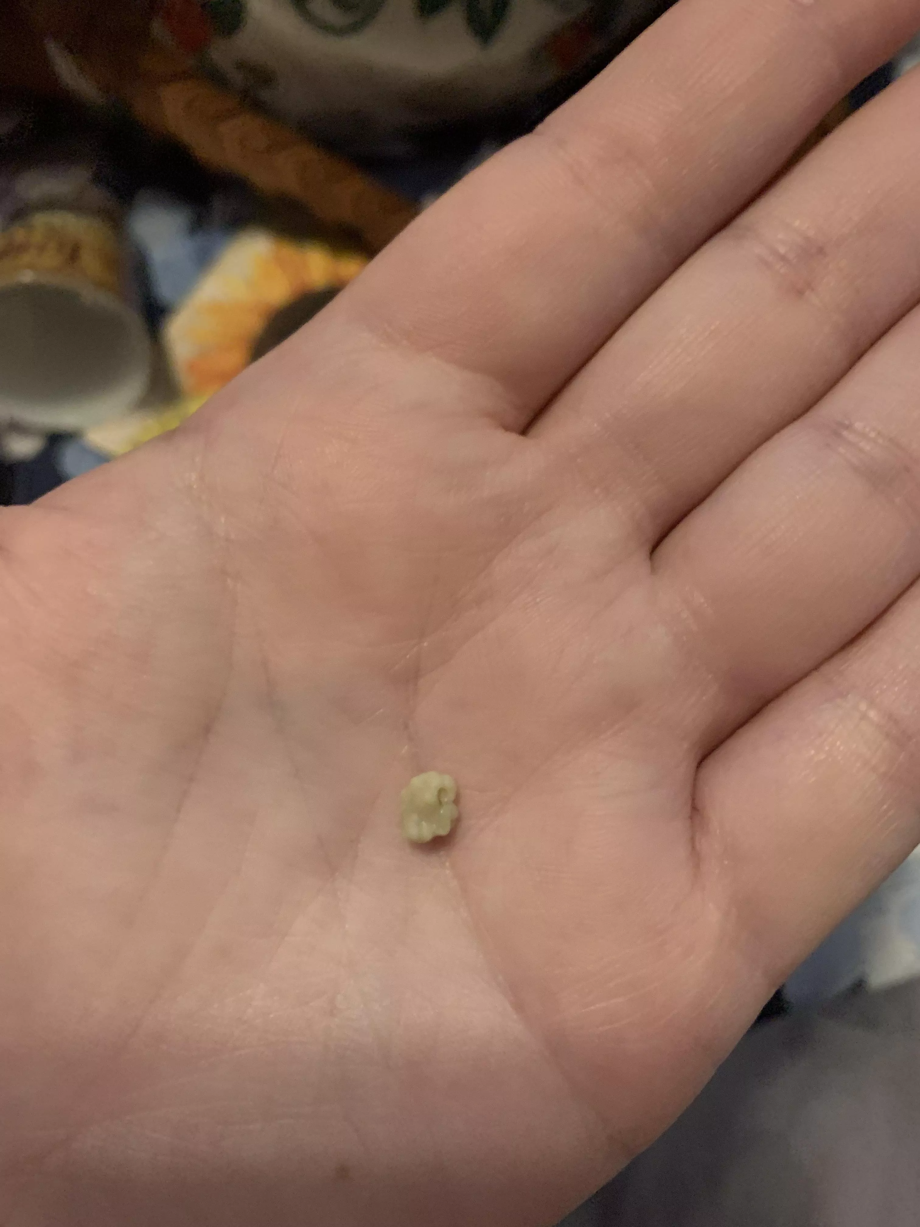 My biggest tonsil stone ever
