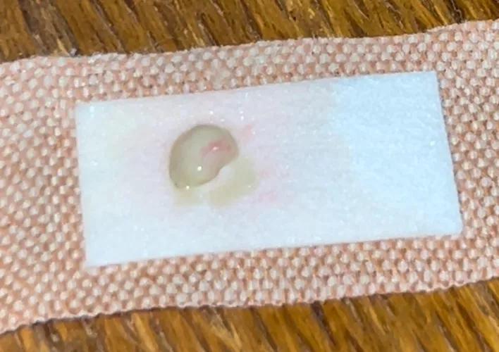 New one for me… an entire, unbroken abscess sac in one piece. Yes, I did my own alien autopsy on it later.