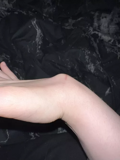 Third Ganglion Cyst After 2 Surgeries