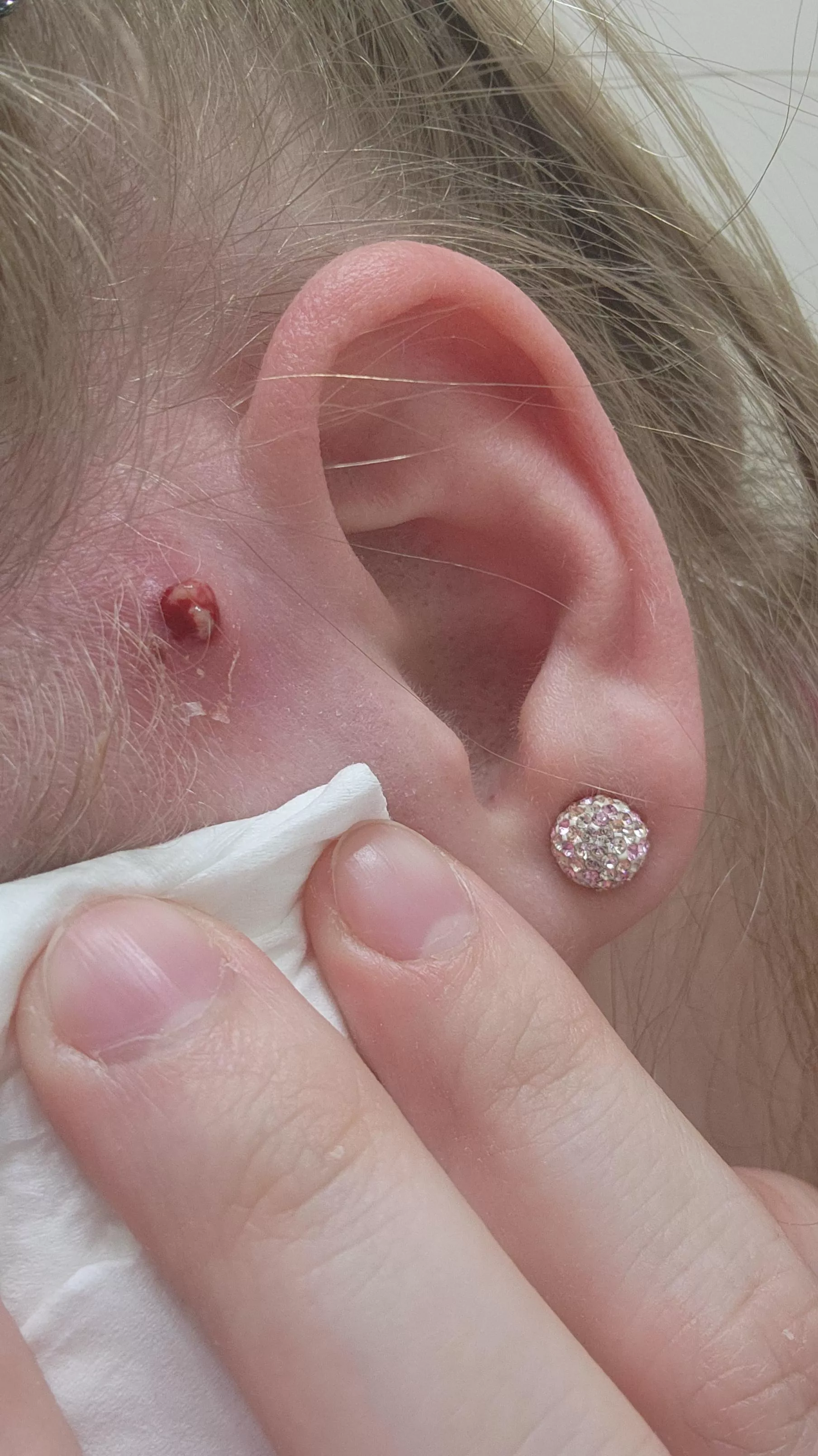 Well guess my MRSA came back again, she is angry 😅