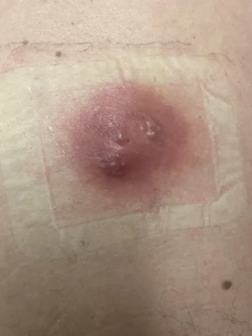 Infected cyst/abscess on my Dads back (taking 10 days antibiotics before they lance it)