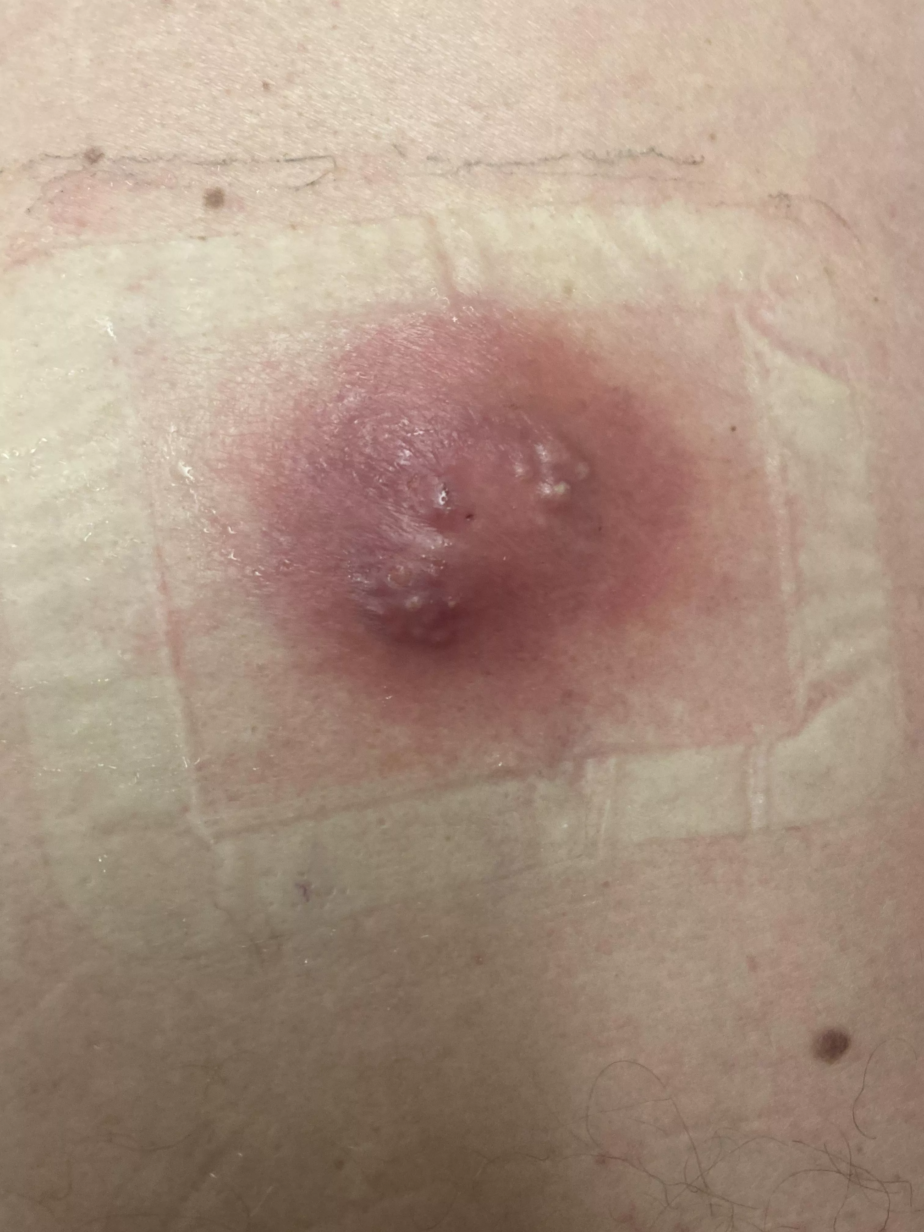 Infected cyst/abscess on my Dads back (taking 10 days antibiotics before they lance it)