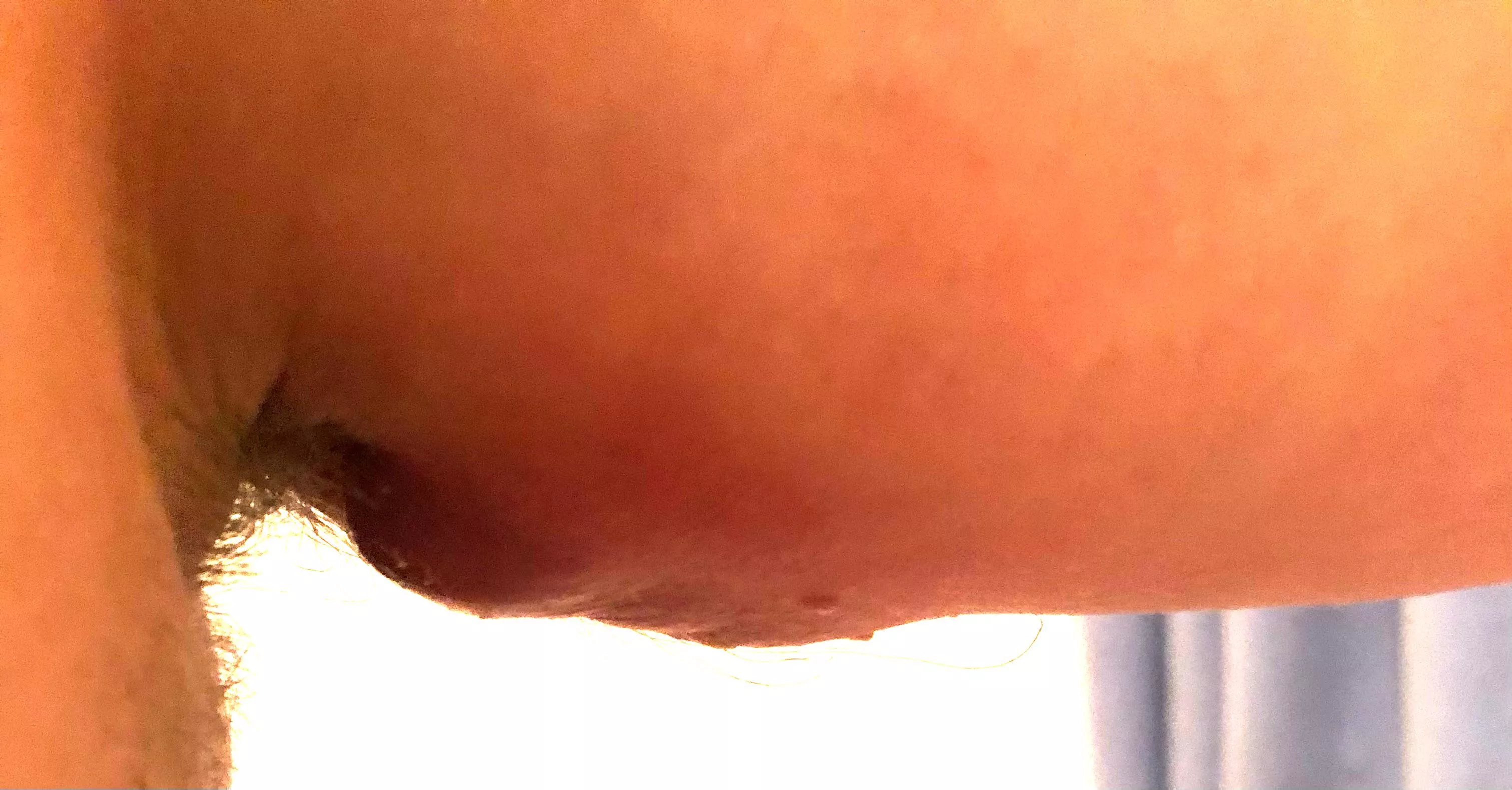 Pic of my painful boil that a surgeon will hopefully drain today