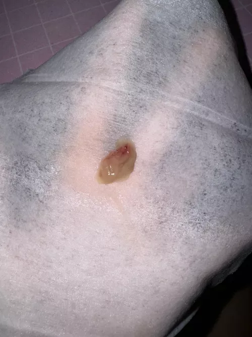 Coughed up this mucus plug. I feel like a whole new person and finally got my voice back