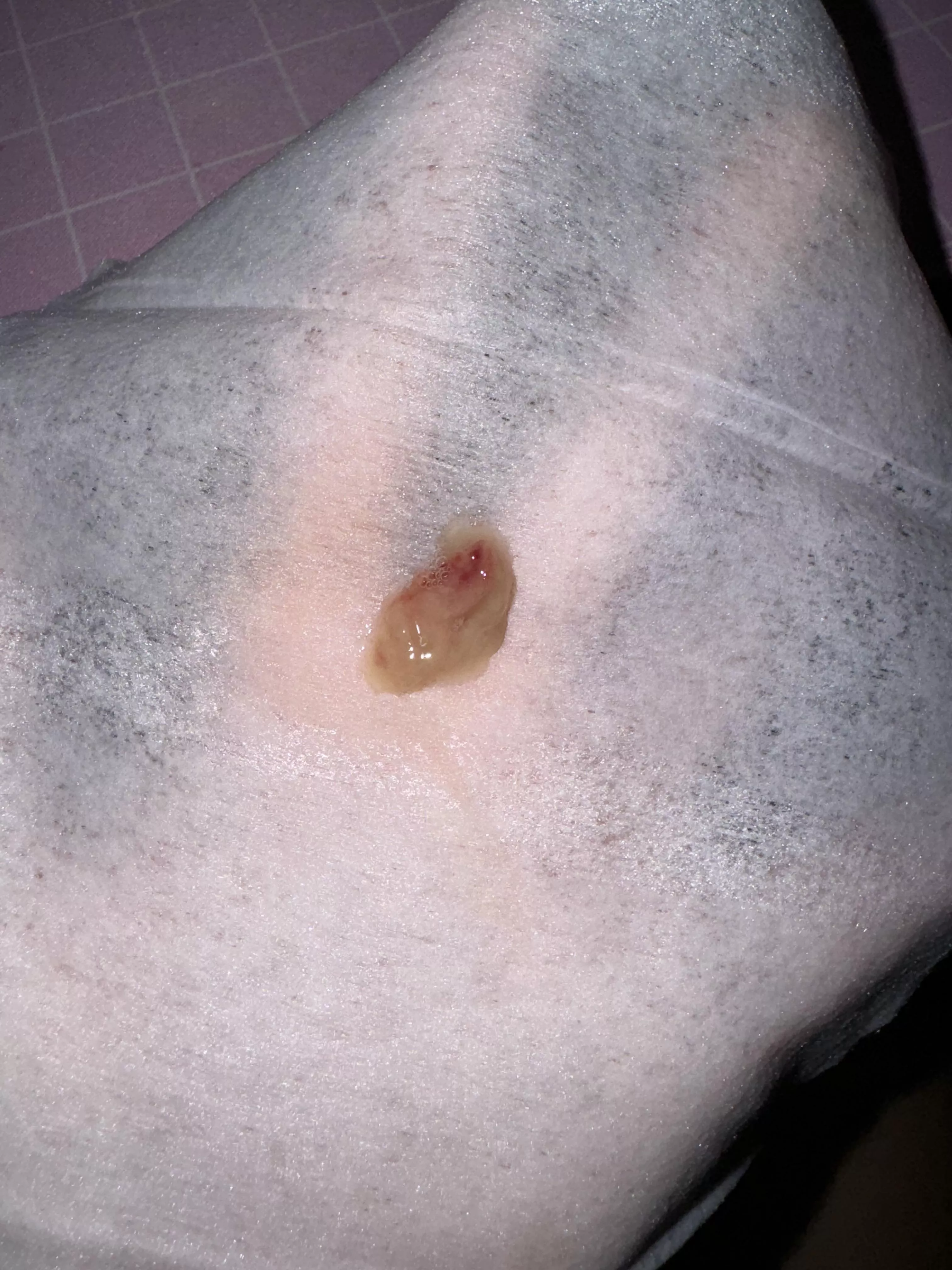 Coughed up this mucus plug. I feel like a whole new person and finally got my voice back