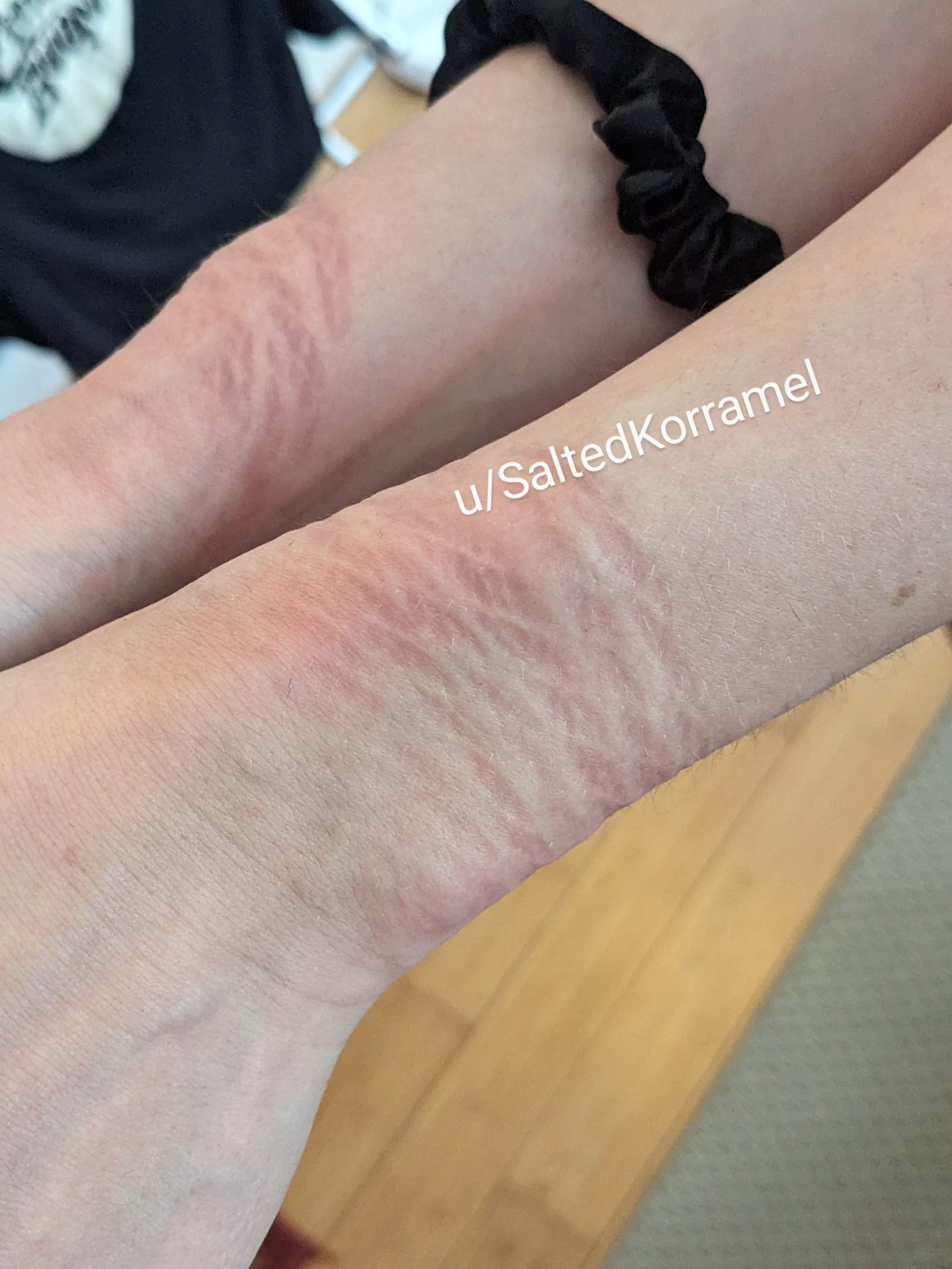Insane rope marks on my wrists after being bound to a chair and made to cum