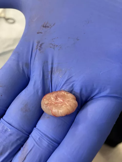 Cyst removal - scalp