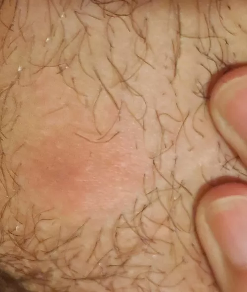 This cyst(?) has been forming for a week. Can't wait for the head to come up! (NSFW for location)