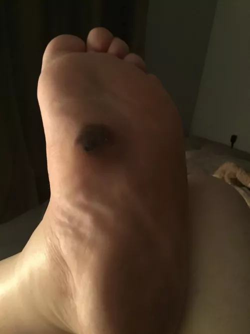 Want to pop - blood blister on top of cyst