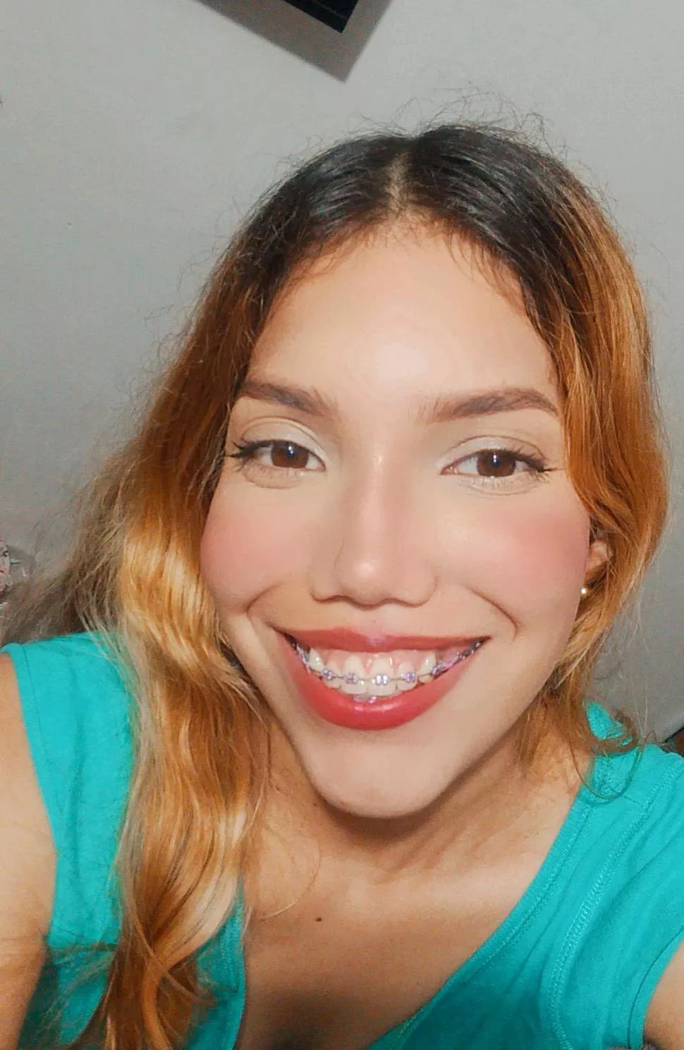 My braces are now a pretty lilac color.