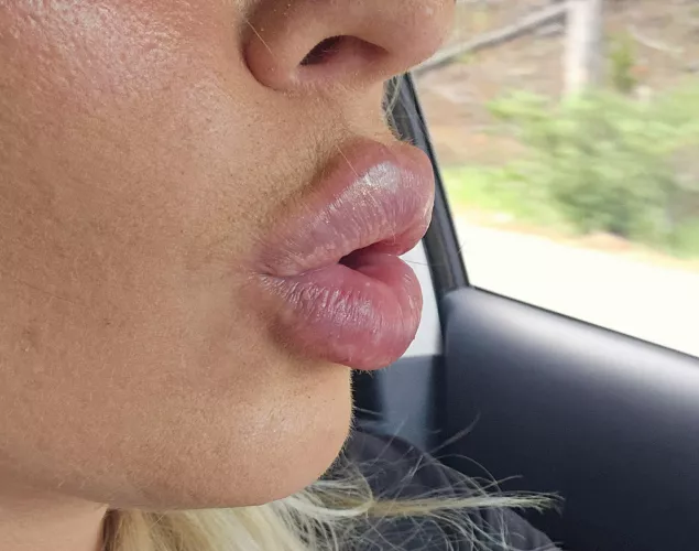 thick filler lips