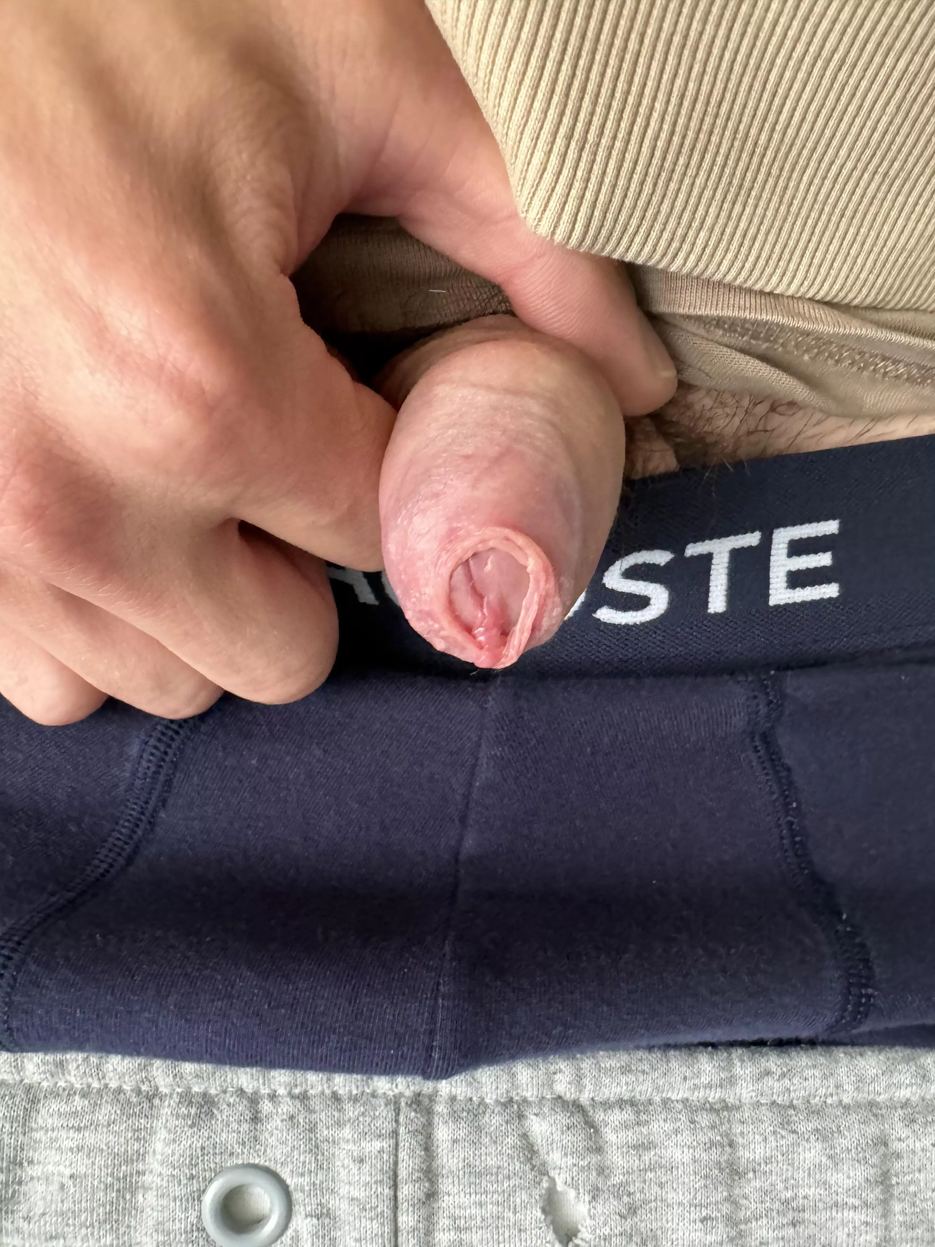 Phimosis, short Frenulum issues please help or advise! Will stretching help? 