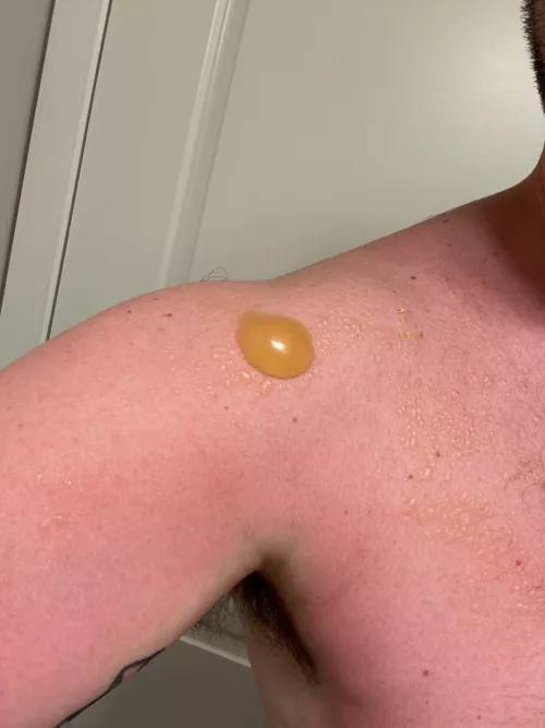 Did not reapply… sun poisoning.