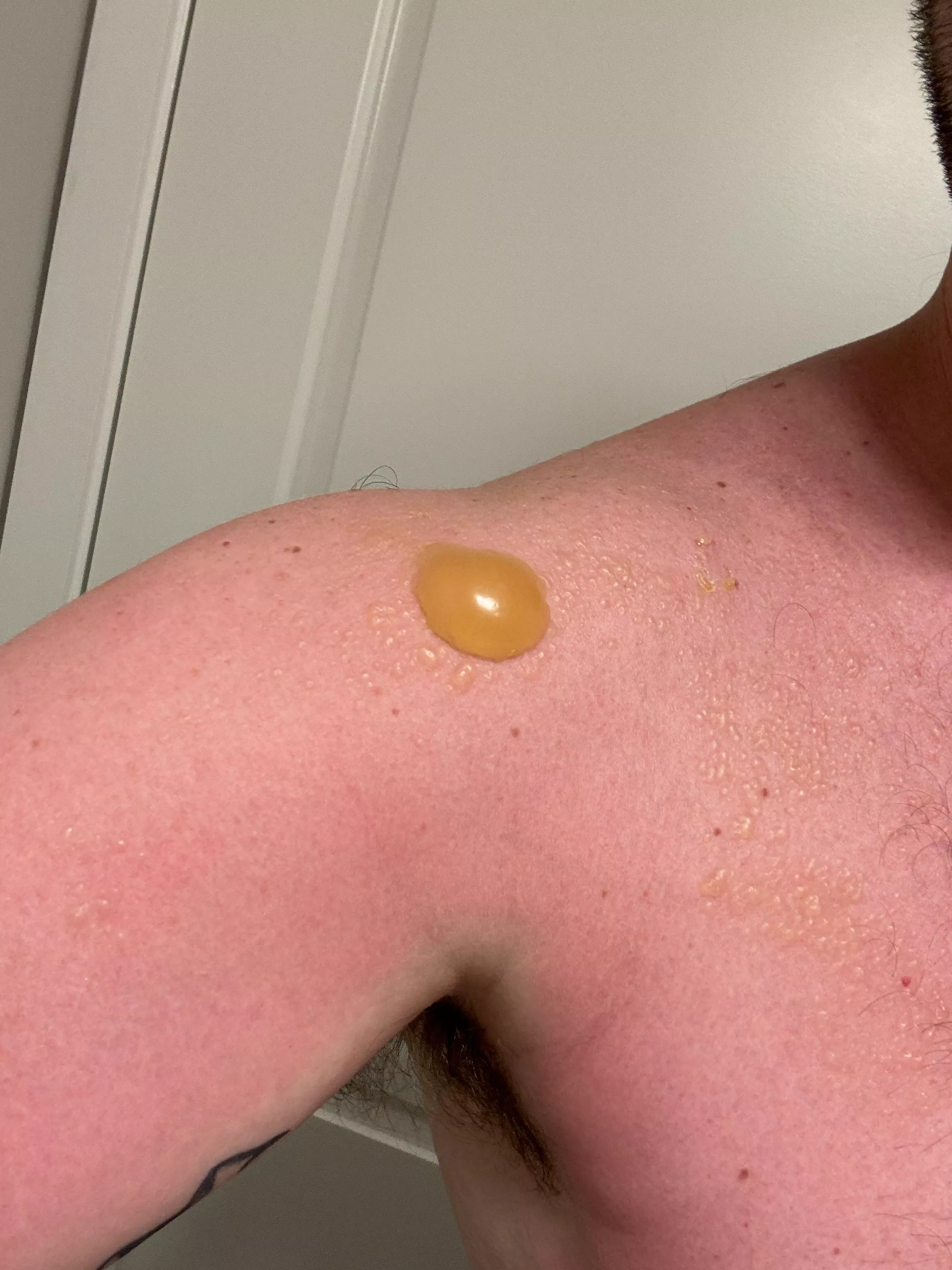 Did not reapply… sun poisoning.