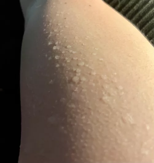 Sweating after a sunburn leads to the worst bubble wrap 
