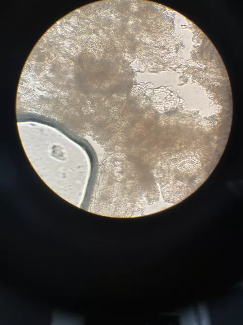 Milia under microscope