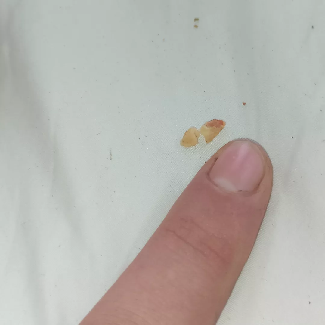 This piece of wax was right on my eardrum for years and I finally got it (the relief omg)