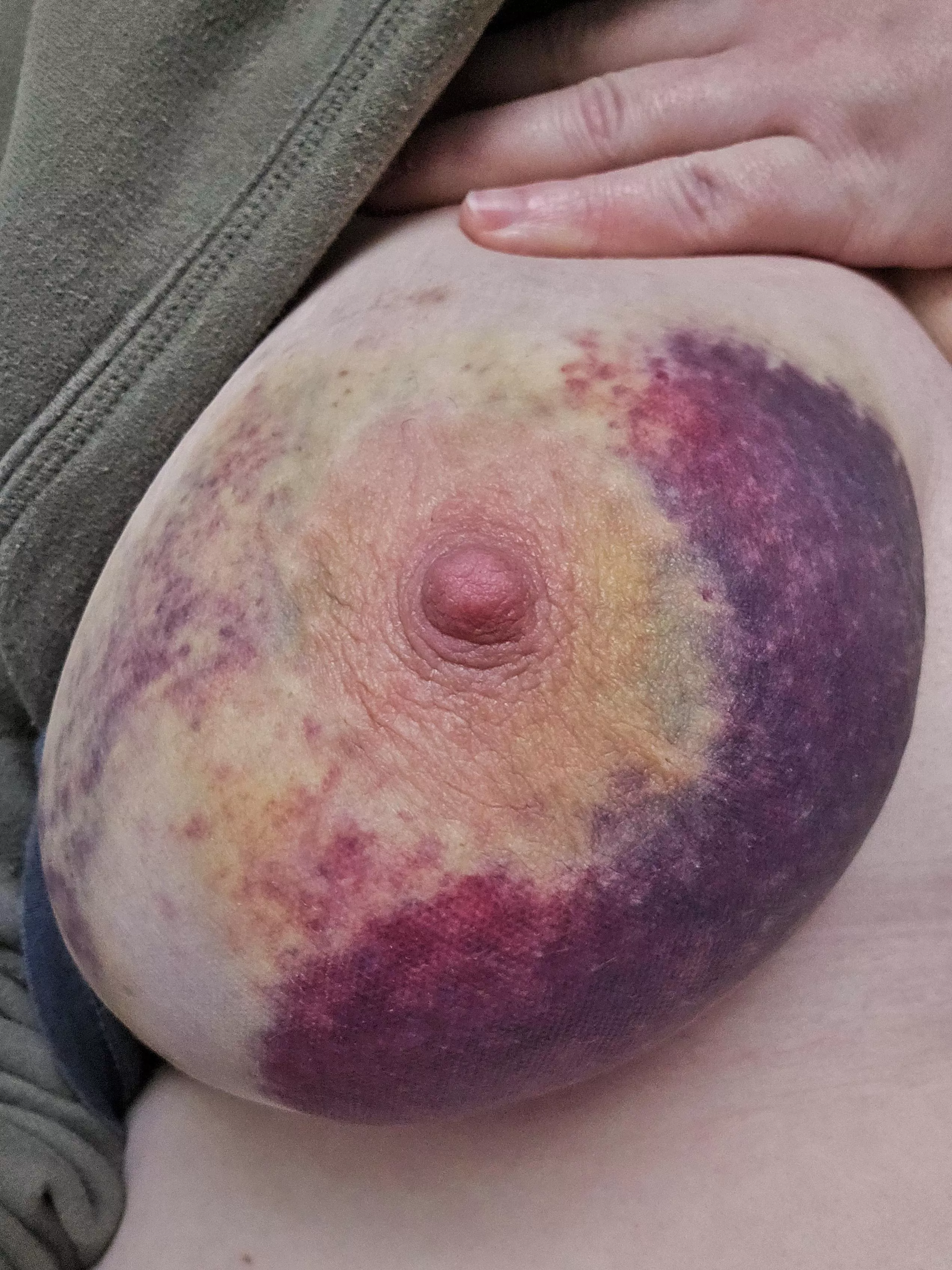 Day 3 bruises from a breast impact session 
