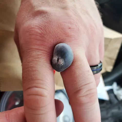 Forbidden pop - my husband got his warts froze