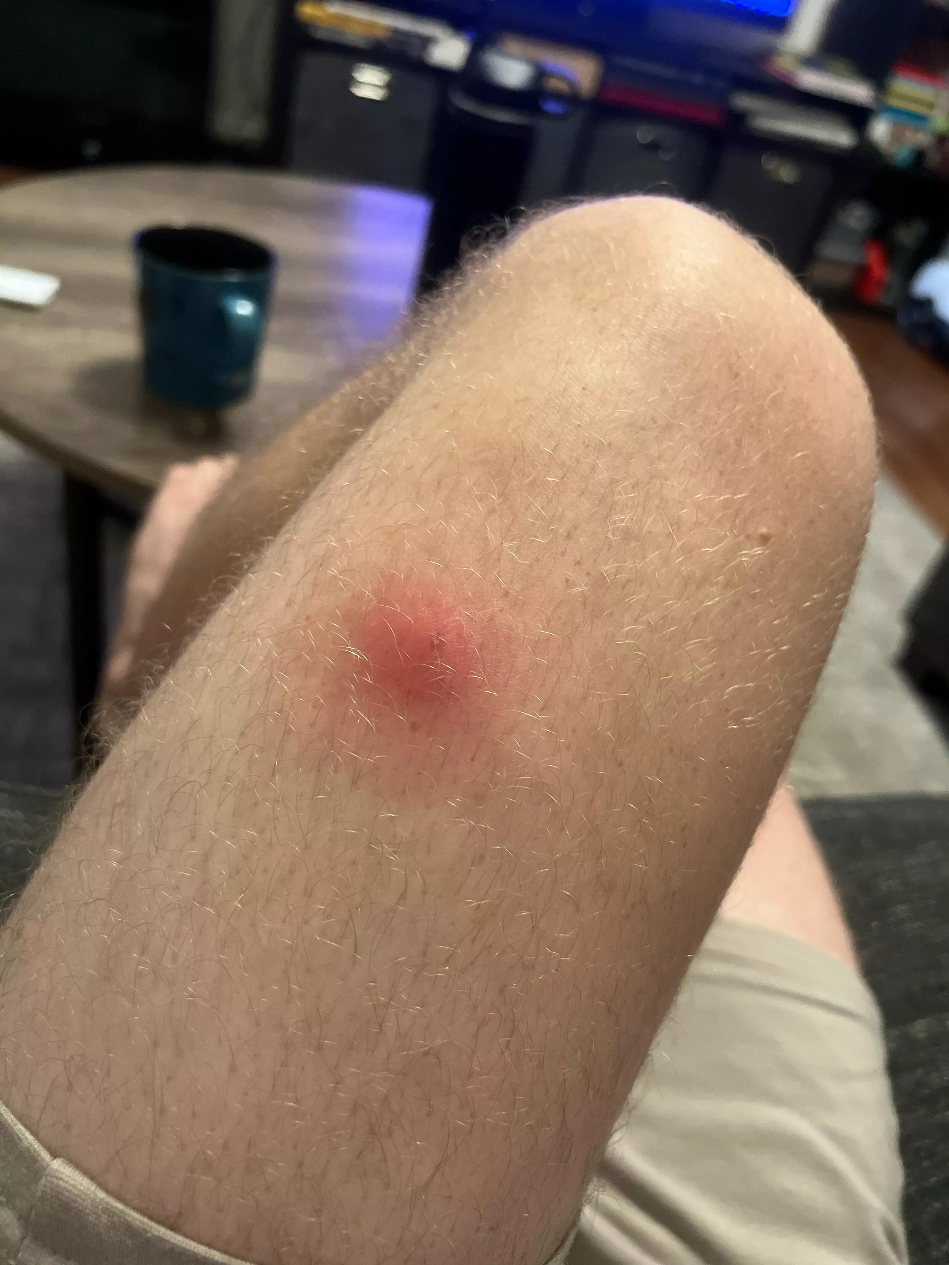I tried popping a zit on my thigh. Inflammation ensues 