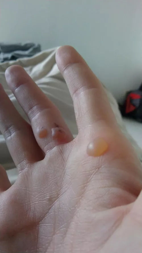 Planter wart removal w/ nitrogen pen