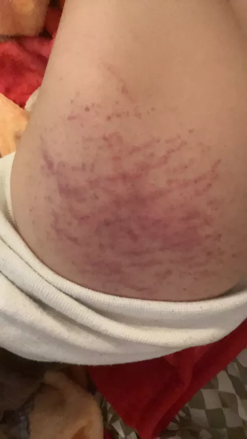 How to get rid of bruises quick