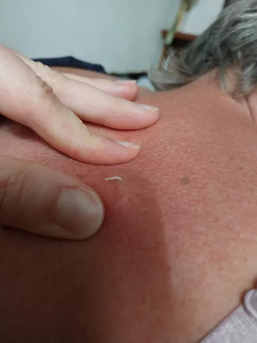My mum had a hard bump on her back..turns out it was a blackhead/cyst 