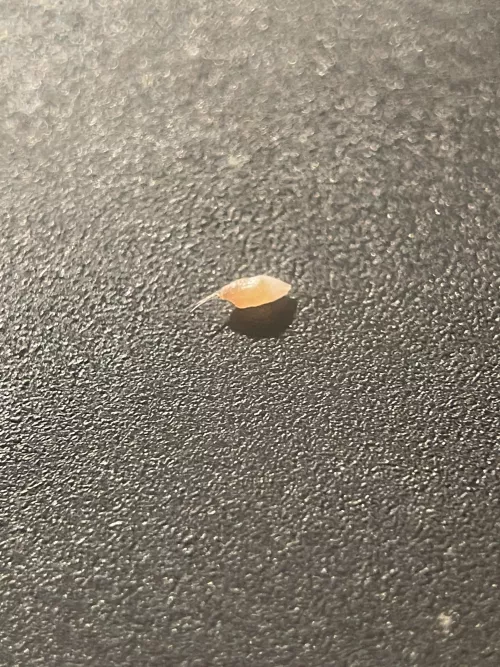 Pulled this out of my face. I thought it was a new psoriasis nodule, but no, ingrown hair