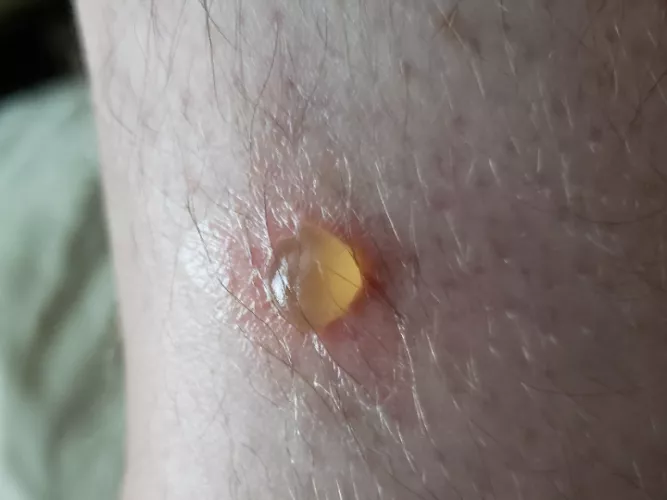 Chigger blister on ankle