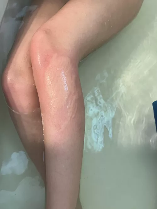 Stung by something in the ocean burning shooting pain any thoughts what it could of been